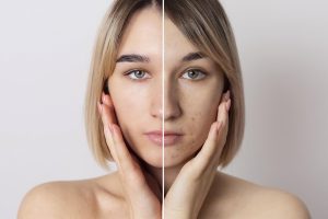 Kurang Air Bisa Bikin Jerawatan? Ini Hubungan Air & Kulitmu